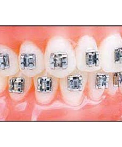 022 Mini Edgewise VS Brackets