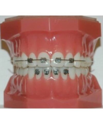 022 Mini Edgewise Vs Double Upper Lateral