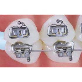ortho-arch-halo-molar-band-and-buccal-tube-and-button