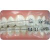 UL/LR Conlin Light Wire Composite Brackets Central Lateral