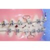 UL/LR Conlin Light Wire Composite Brackets Cuspid Bicuspid