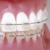 UR/LL Conlin Light Wire Composite Brackets Central Lateral