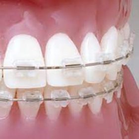 UR/LL Conlin Light Wire Composite Brackets Central Lateral