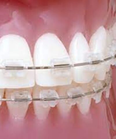 UR/LL Conlin Light Wire Composite Brackets Central Lateral