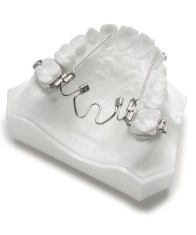 Niti Palatal Expander